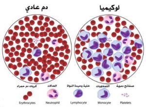 أعراض سرطان الدم