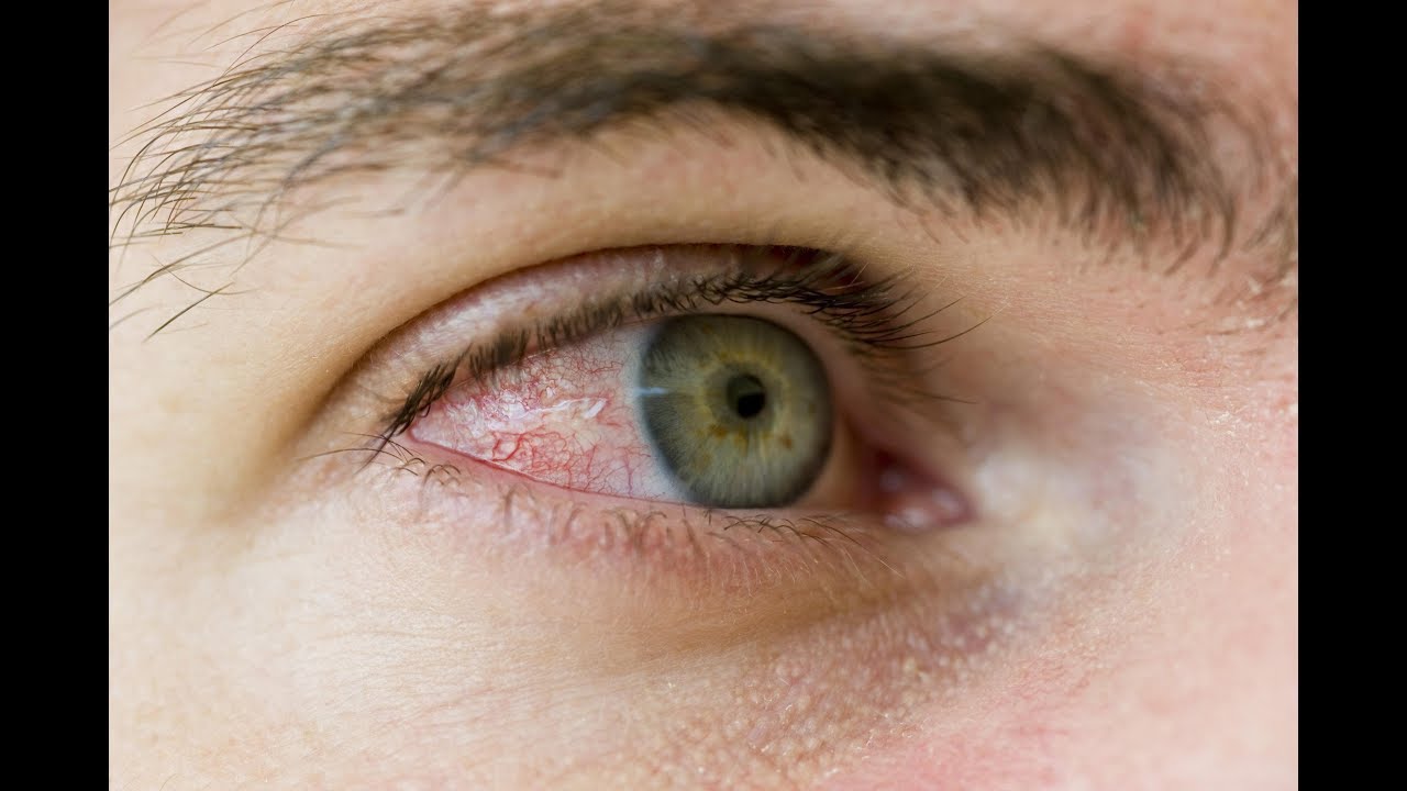علاج اجهاد العين بالاعشاب