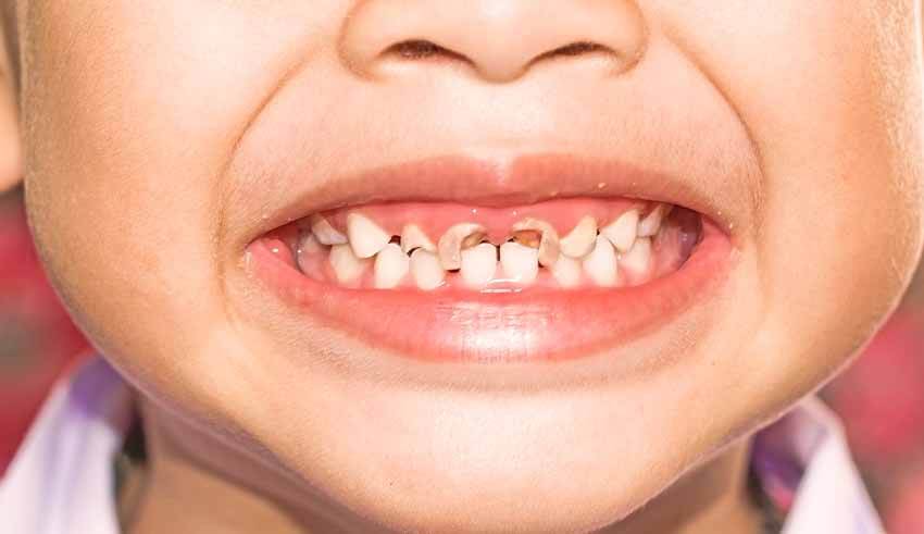 علاج تسوس الاسنان اللبنية عند الأطفال