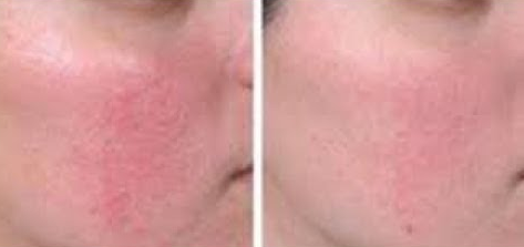 كيفية علاج التهاب بشرة الوجه