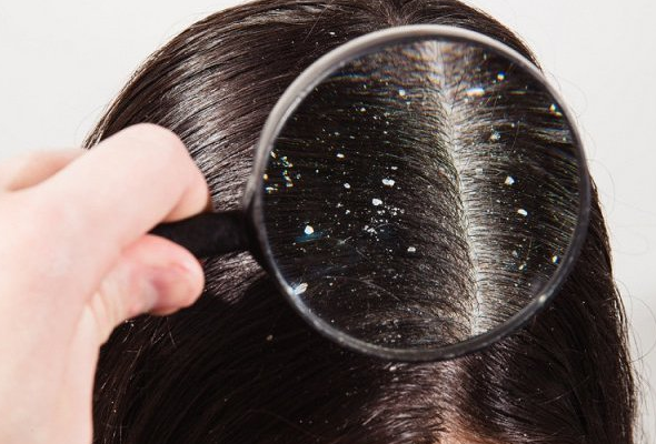 كيفية علاج قشرة الشعر الجاف